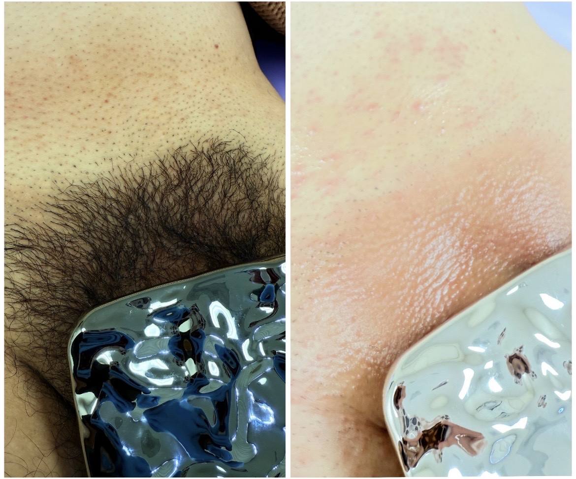 Bikini wax before and after results San Diego